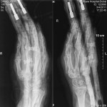 02 X-ray with Flexi kite handles holding wrist in place